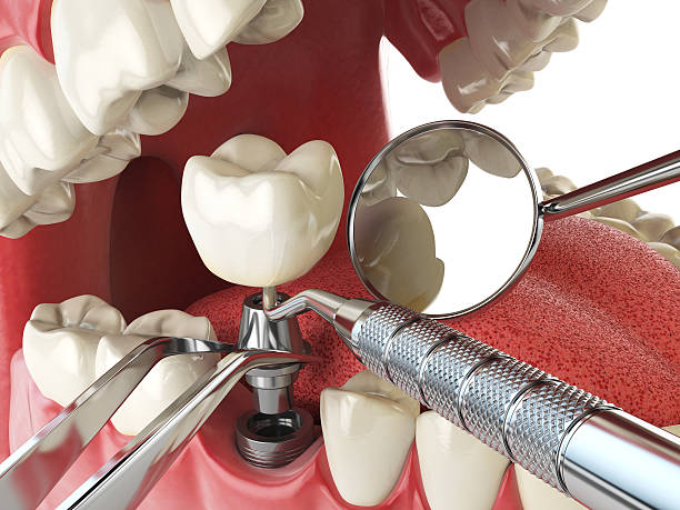 Best Knocked-Out Tooth (Avulsed Tooth) Treatment in Seymour, IN
